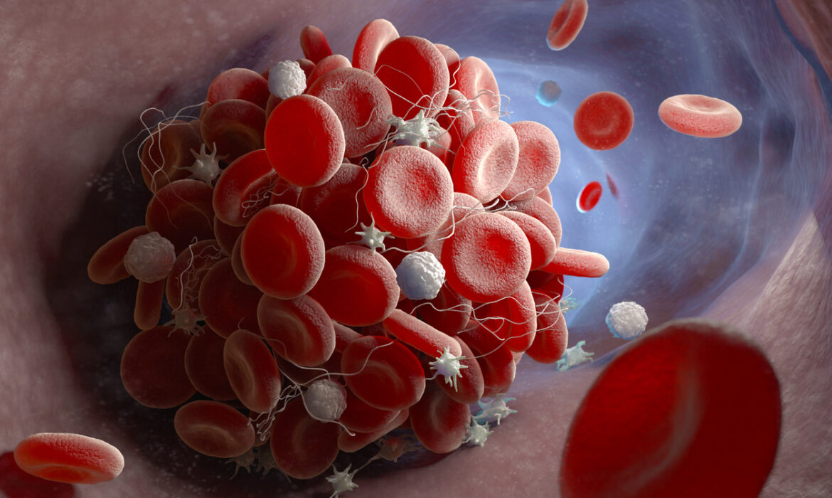 Increased risk of blood clots long after COVID-19